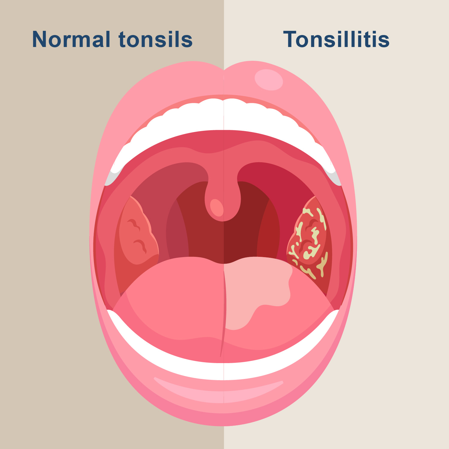 What Is Tonsillitis Learn About Its Symptoms Causes And Treatments 